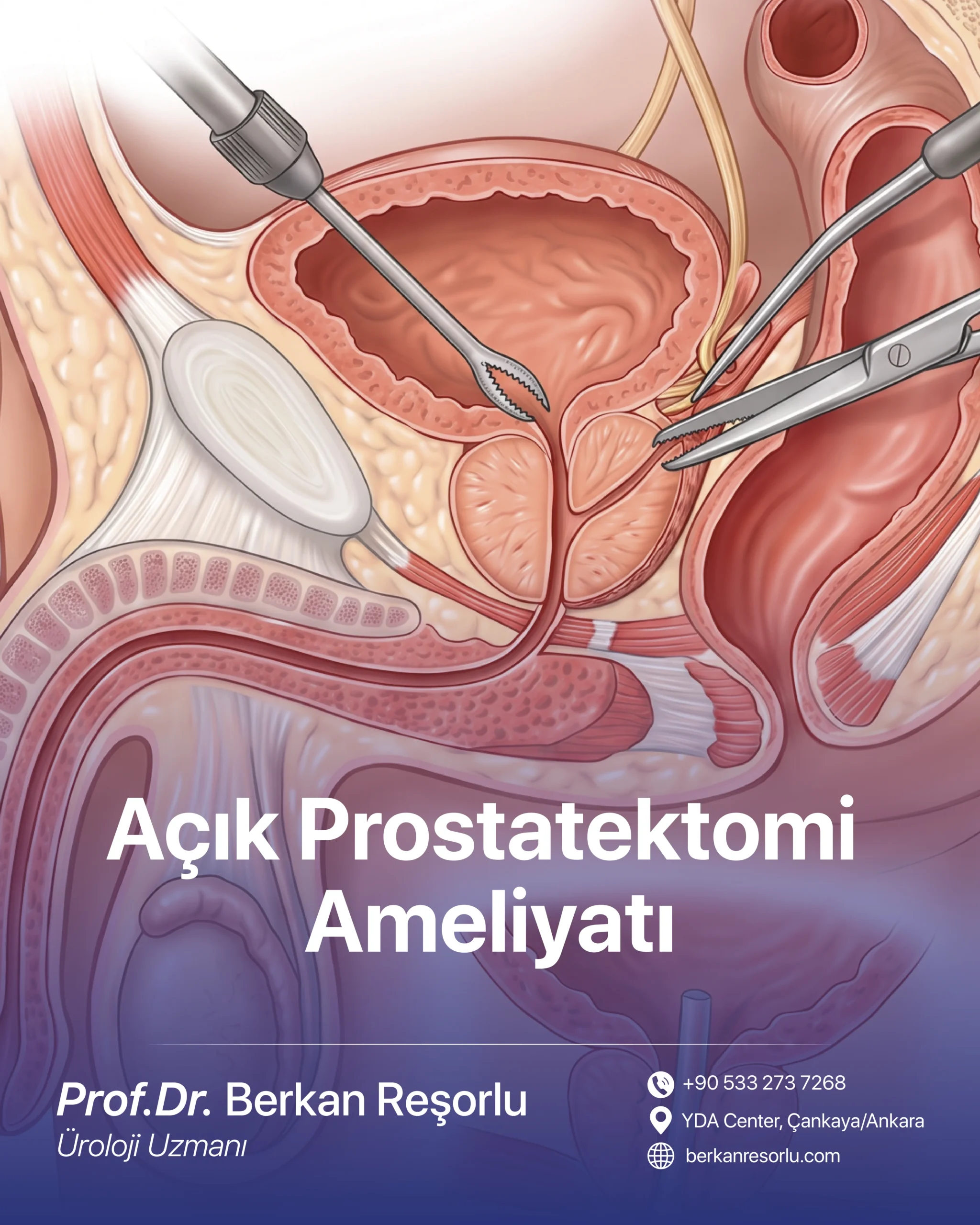 Açık Prostatektomi Ameliyatı