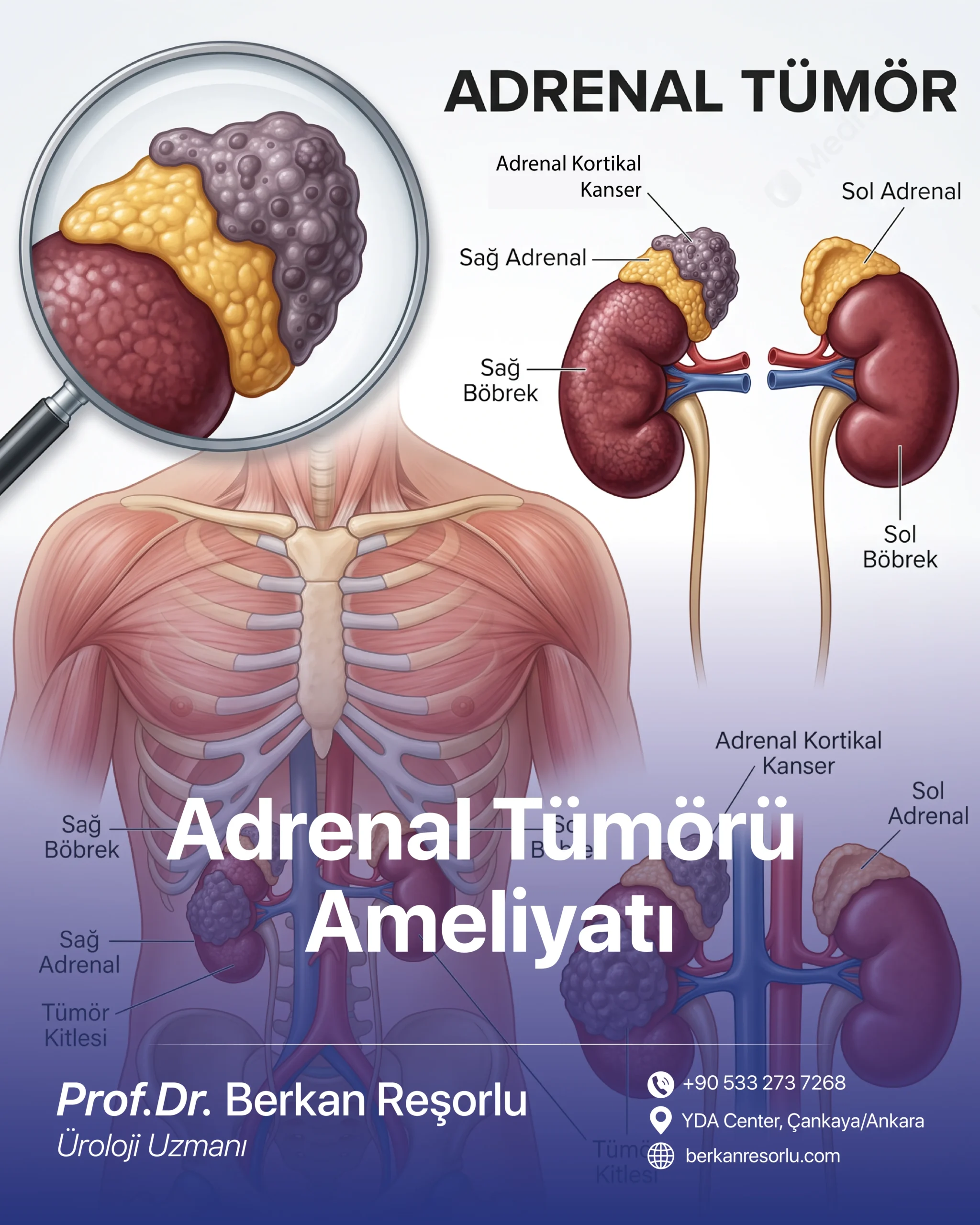 Adrenal Tümörü Ameliyatı