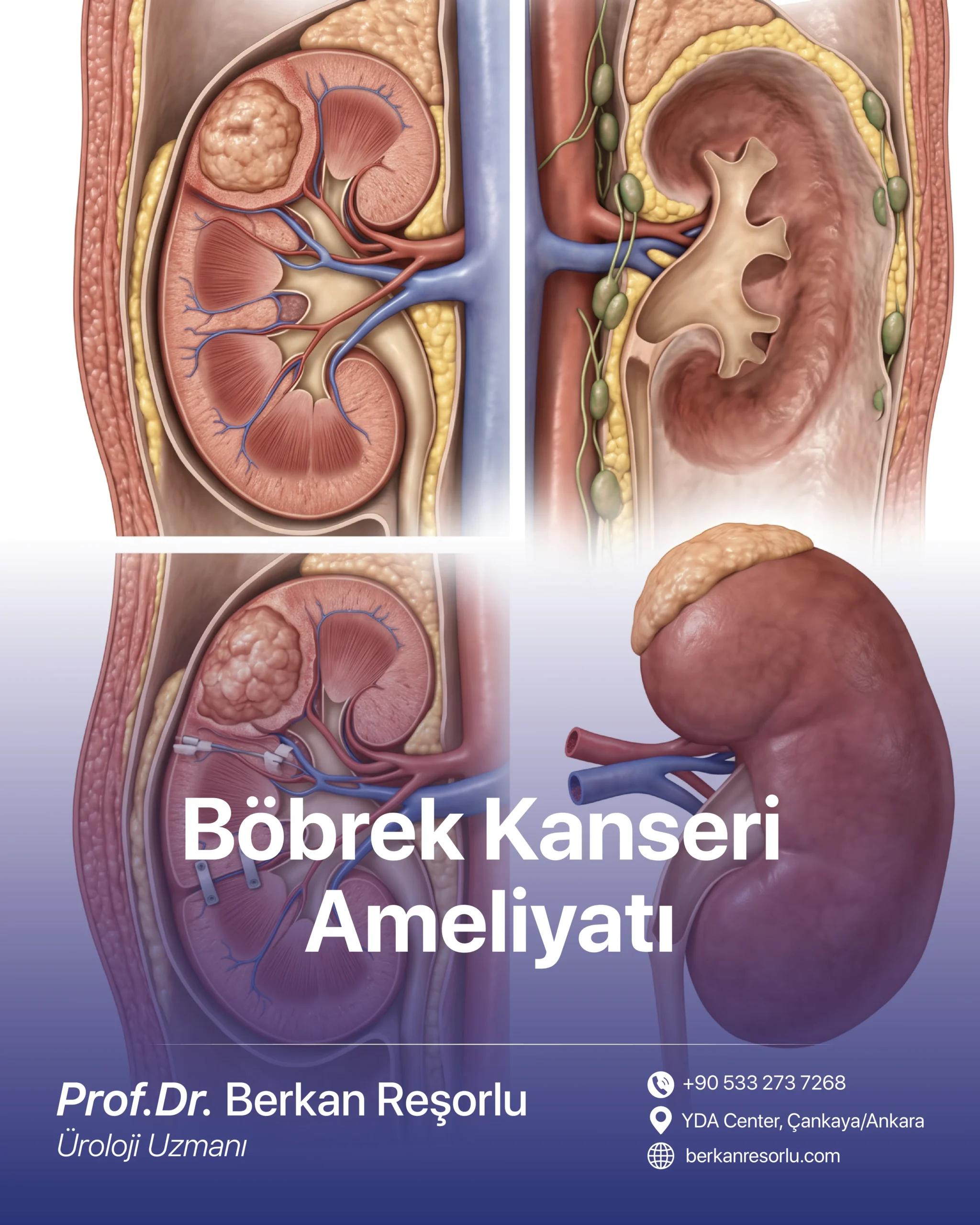 Böbrek Kanseri Ameliyatı