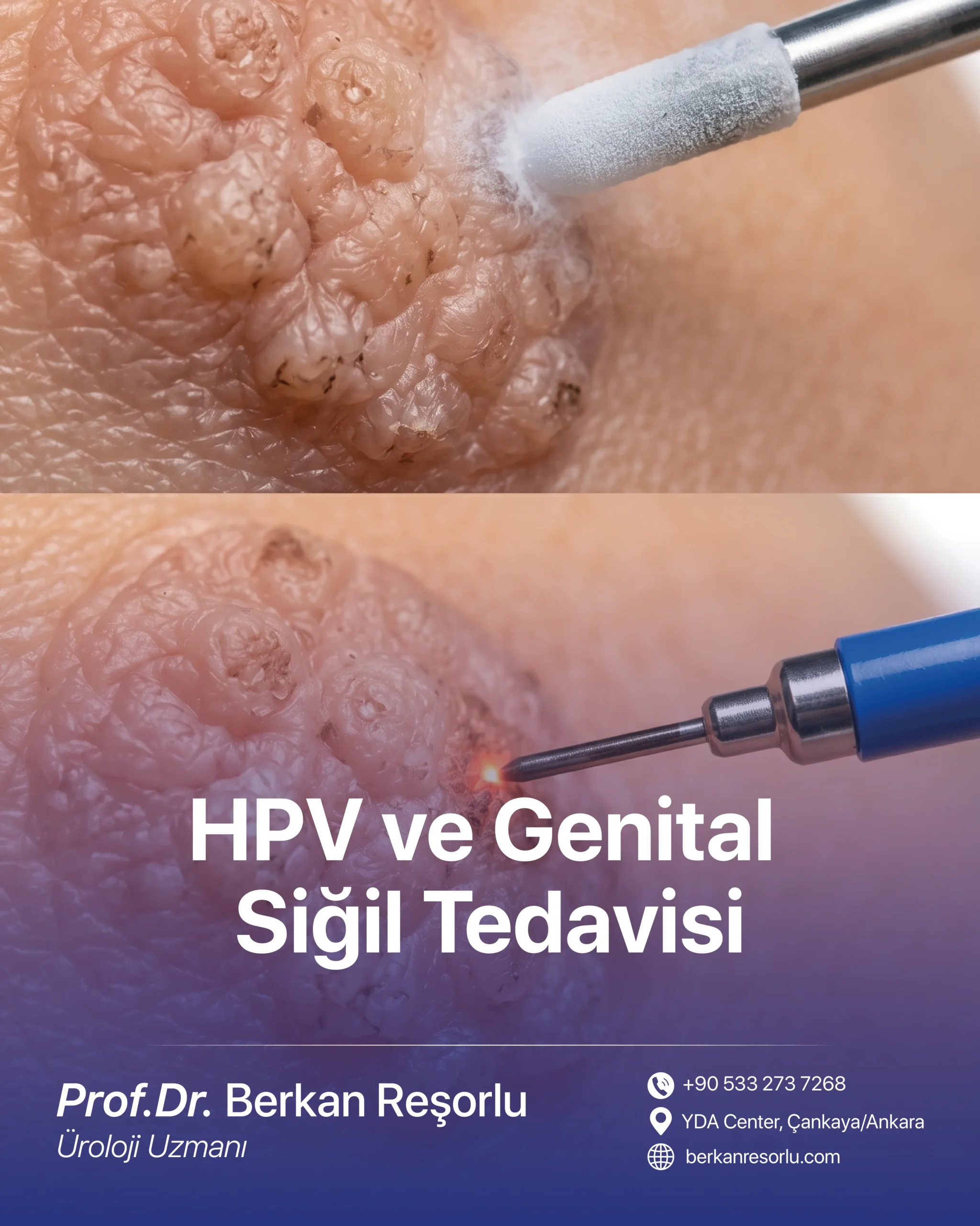 HPV ve Genital Siğil Tedavisi