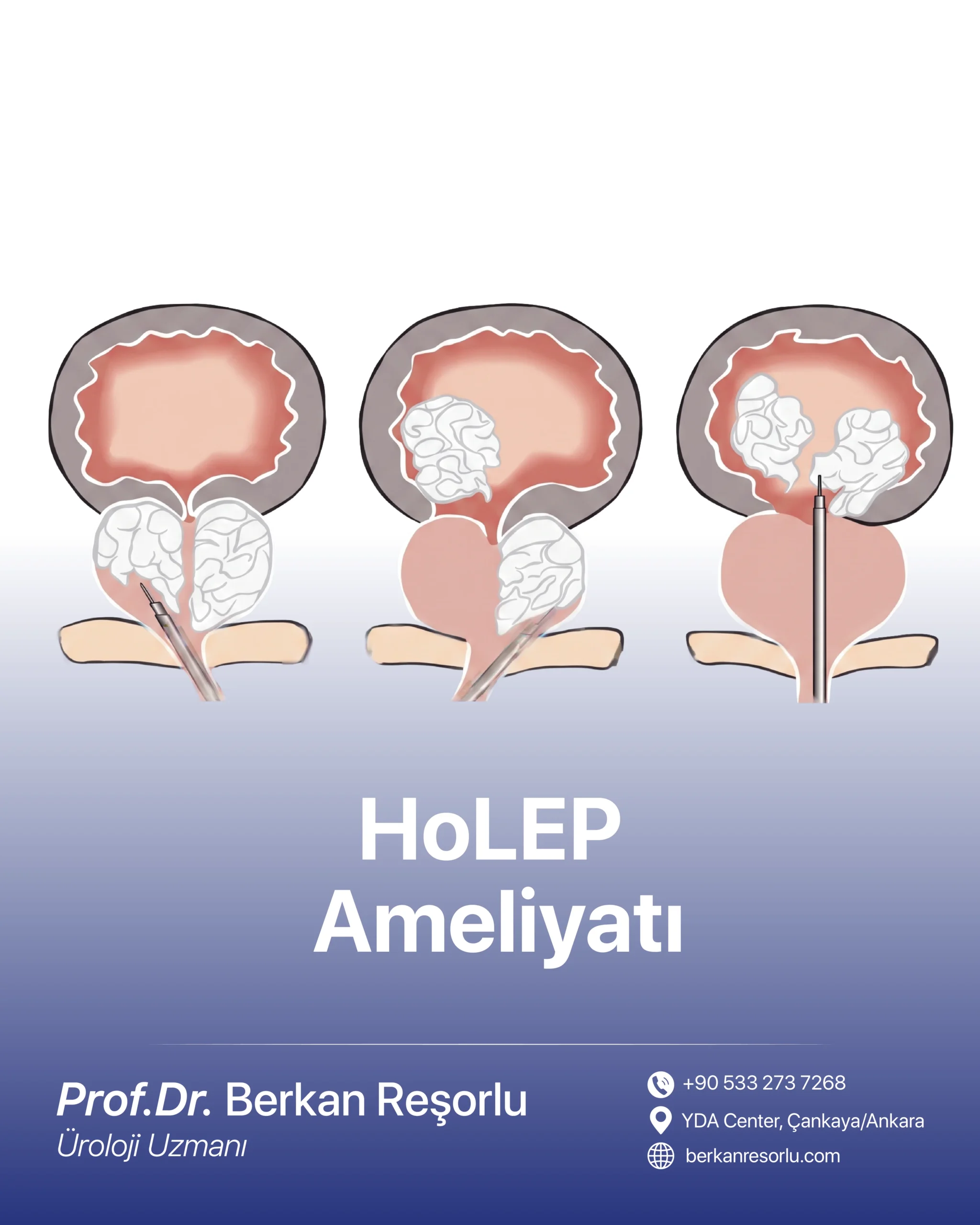 HoLEP Ameliyatı