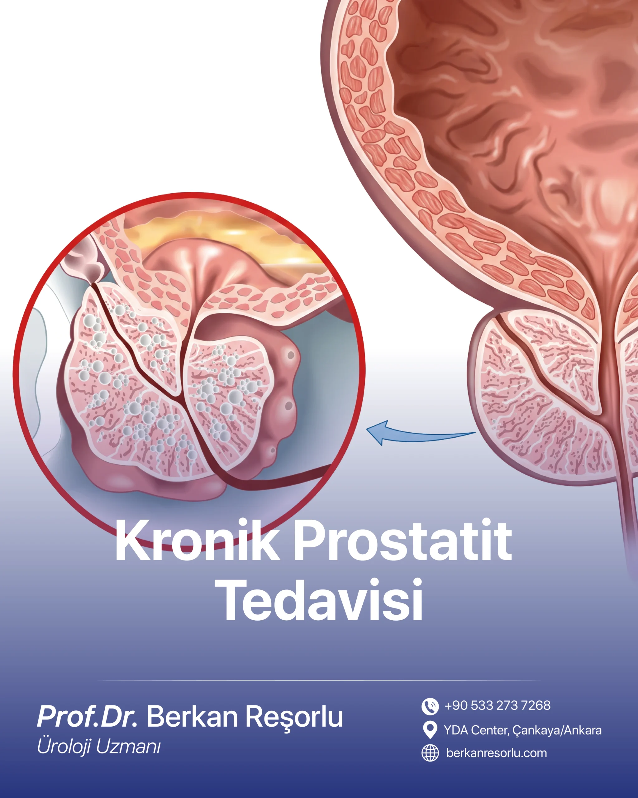 Kronik Prostatit Tedavisi
