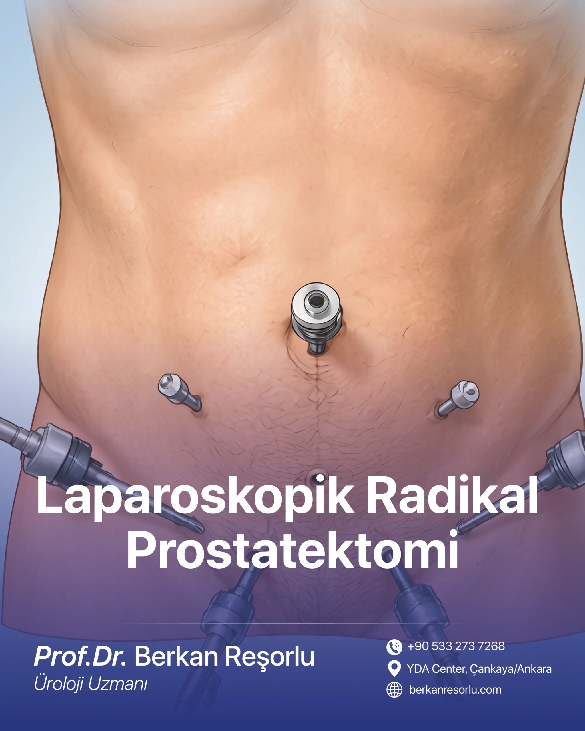 Laparoskopik radikal prostatektomi