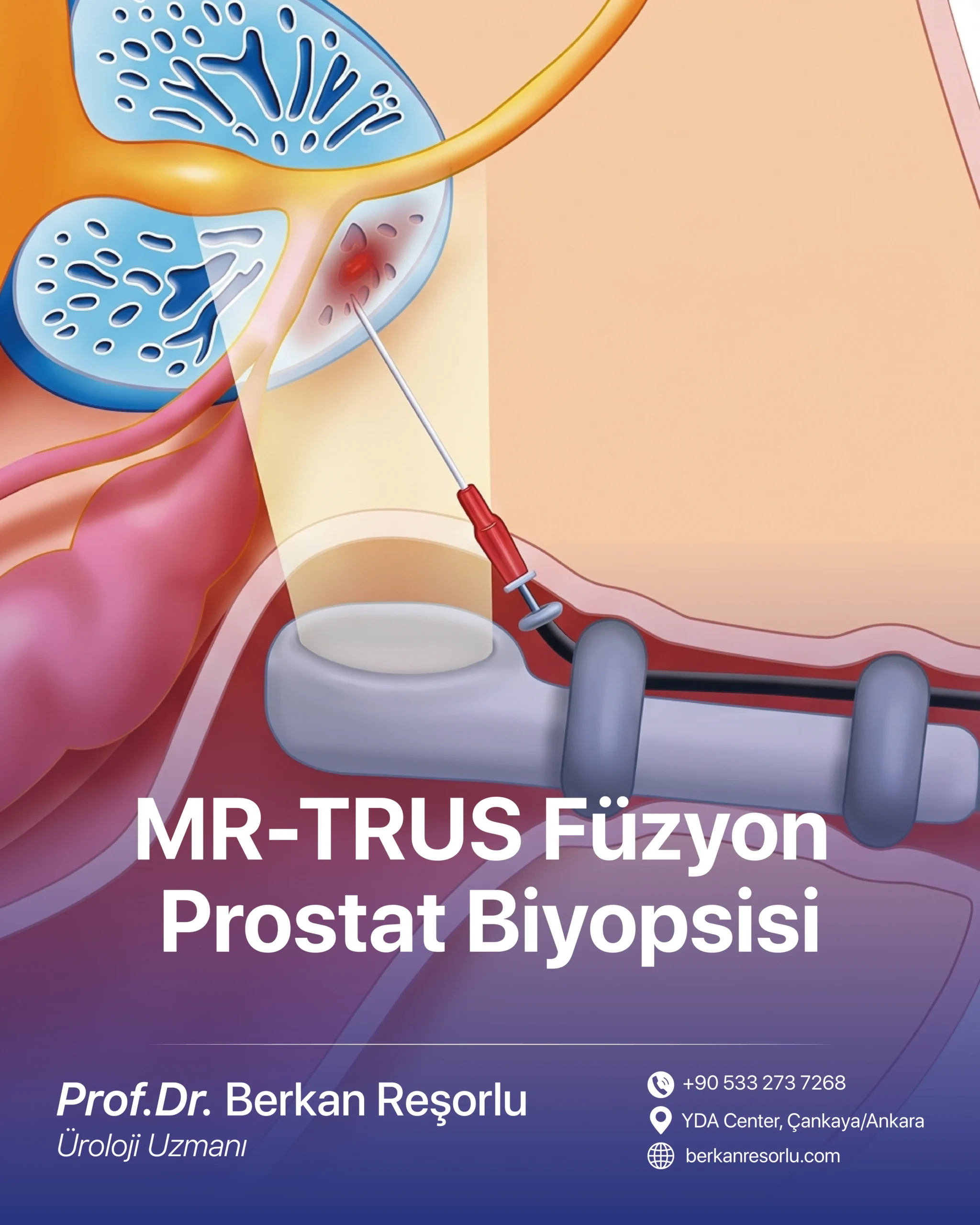 MR-TRUS Füzyon Prostat Biyopsisi