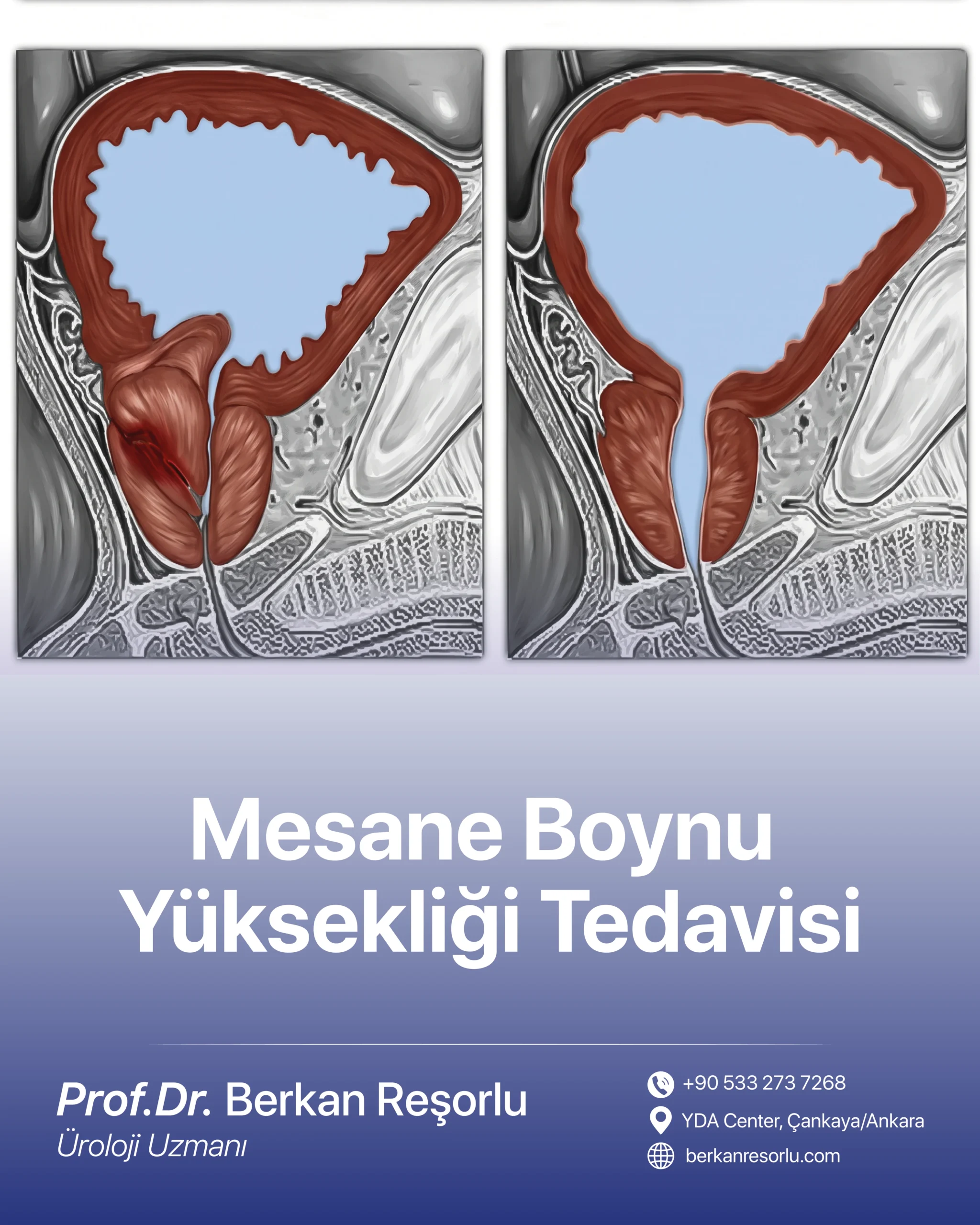 Mesane Boynu Yüksekliği Tedavisi