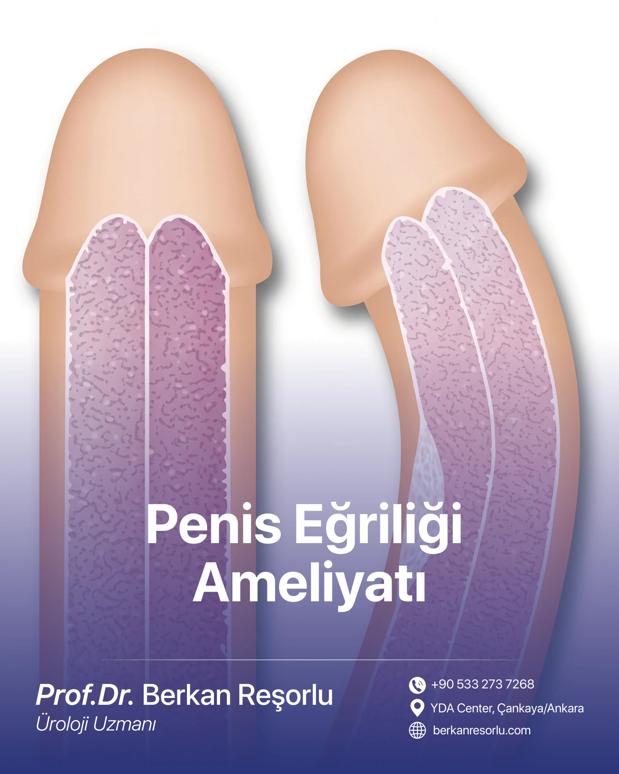 Penis Eğriliği Ameliyatı