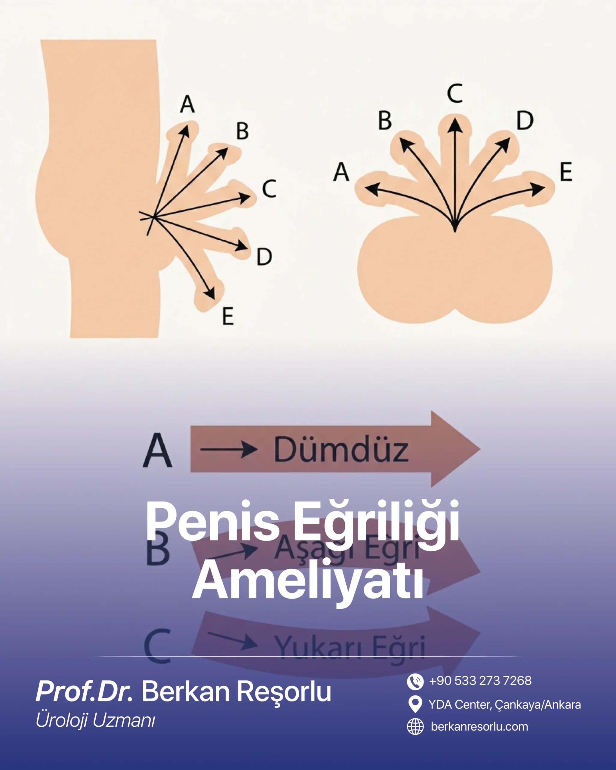 Penis Eğriliği (Peyronie) Ameliyatı