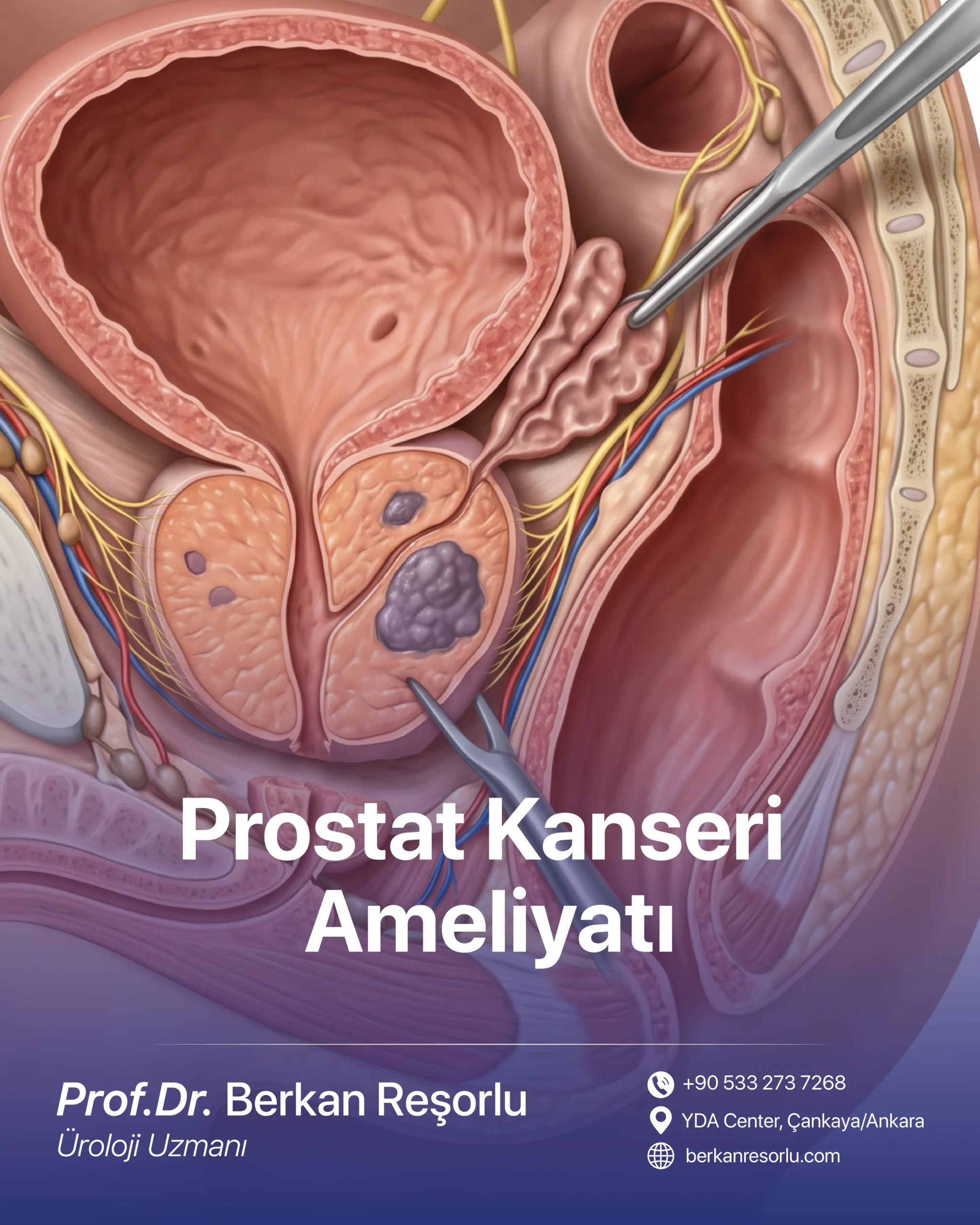 Prostat Kanseri Ameliyatı