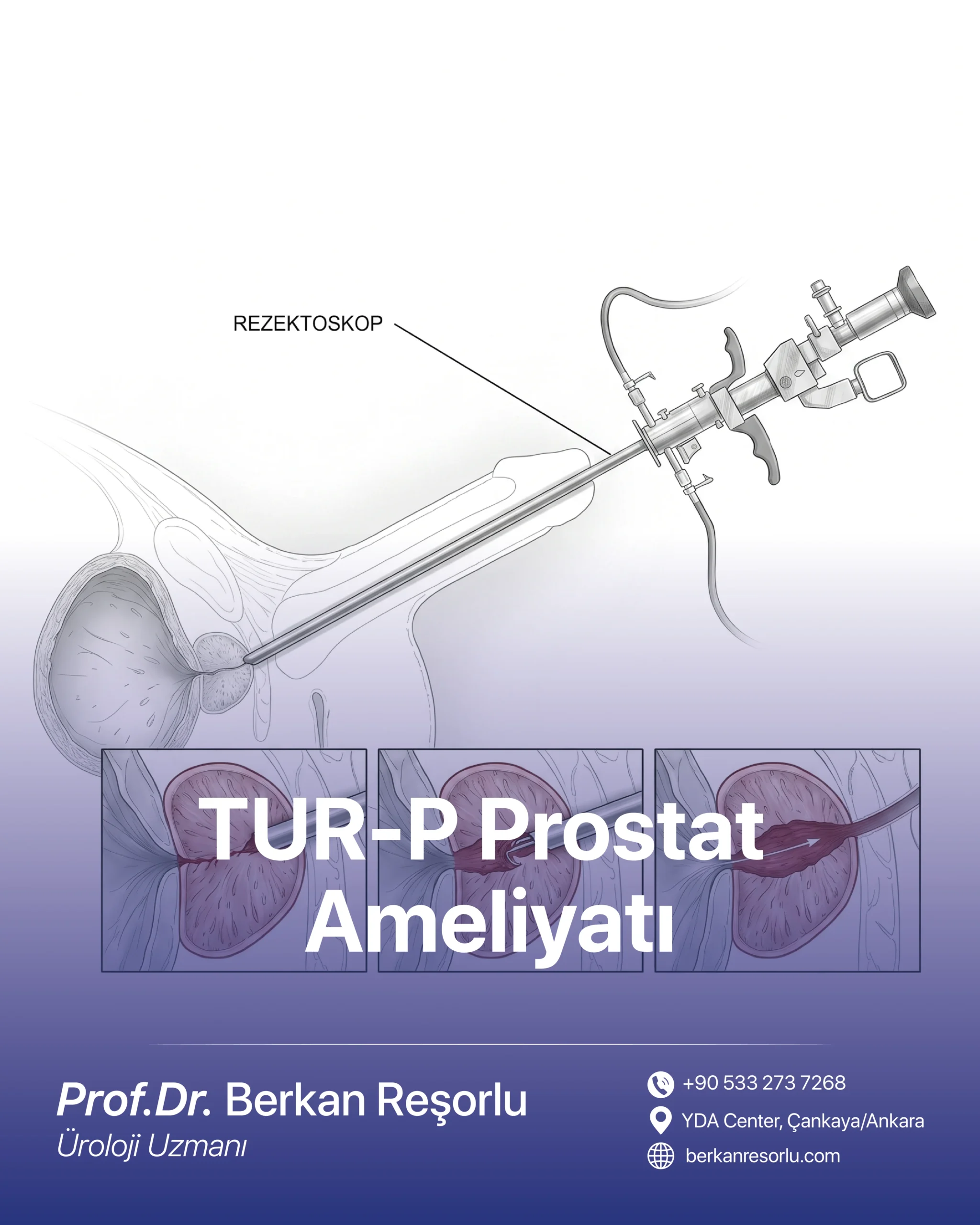 TUR-P Prostat Ameliyatı