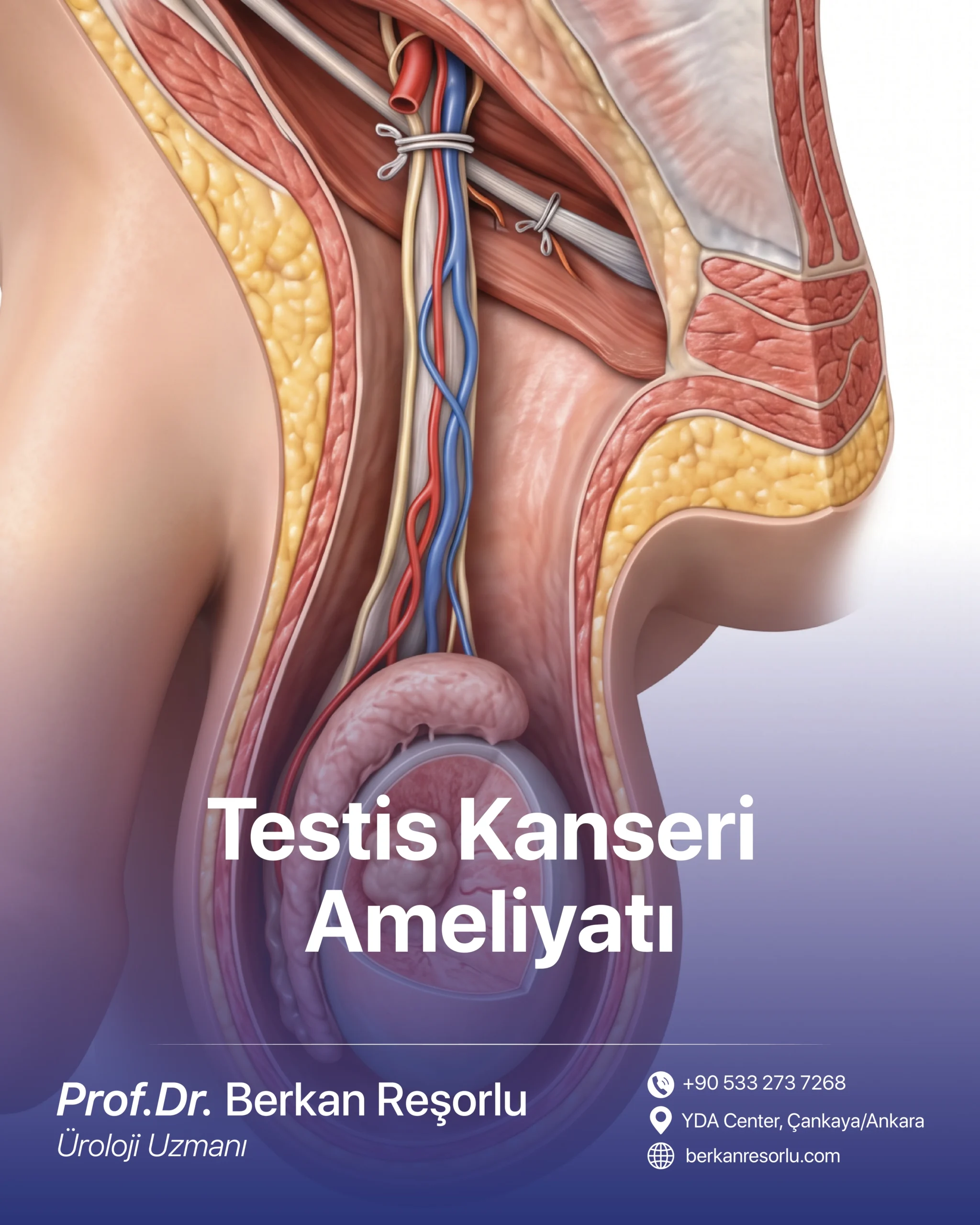Testis Kanseri Ameliyatı
