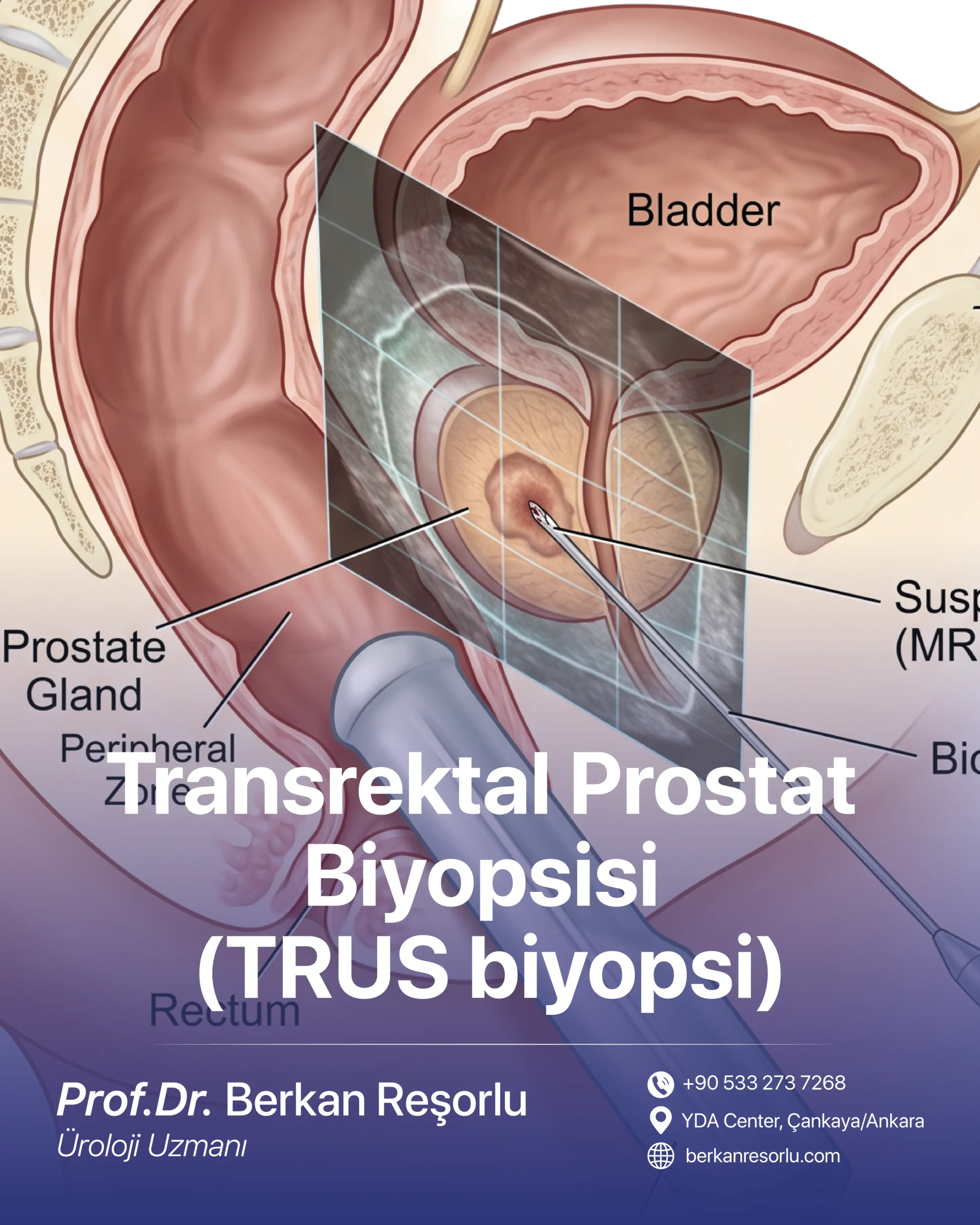 Transrektal Prostat Biyopsisi (TRUS biyopsi)